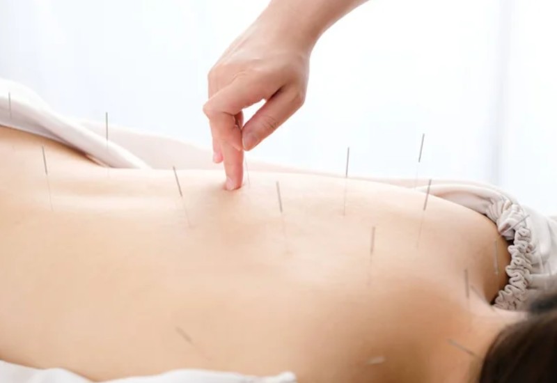 Akupunktura za ublažavanje bolova