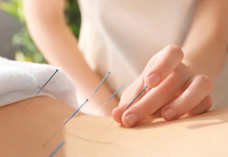 akupunktura